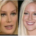 Beauty Yay or Nay? Heidi Montag’s Cosmetic Surgery